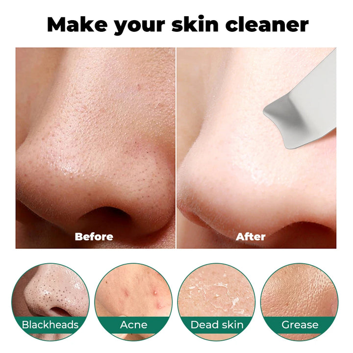 Ultrasonic Skin Scrubber for Deep Cleansing and Exfoliation