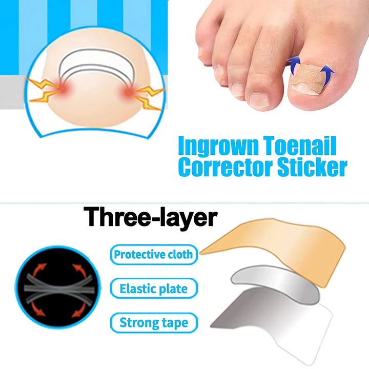 Professional Ingrown Toenail Treatment Set with Correction Patches and Pedicure Tools